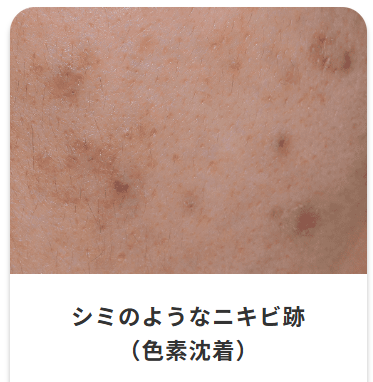 シミのようなニキビ跡