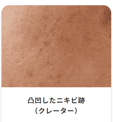 凹凸したニキビ跡