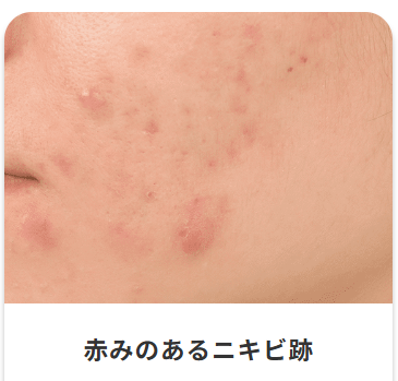 赤みのあるニキビ跡