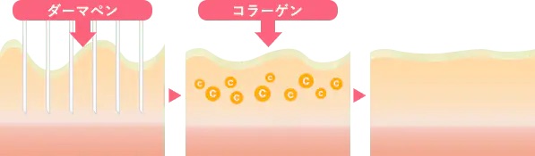 ハリ・ツヤ付与とダーマペンのエイジングケア効果