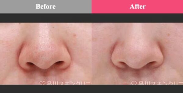 毛穴の開き・黒ずみへのダーマペンの改善効果