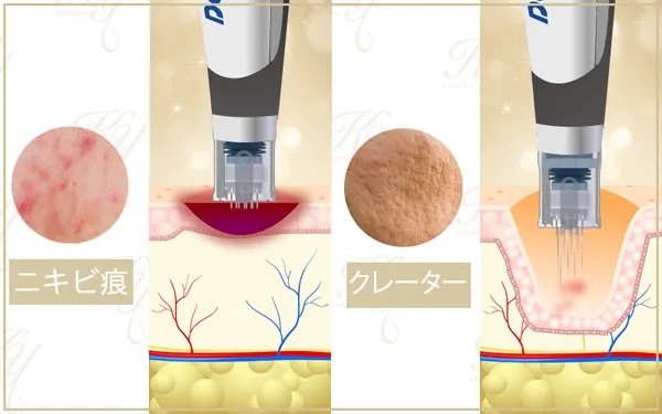 ニキビ跡・クレーターへのダーマペンの改善効果