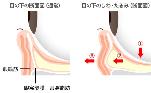 ヒアルロン酸注入