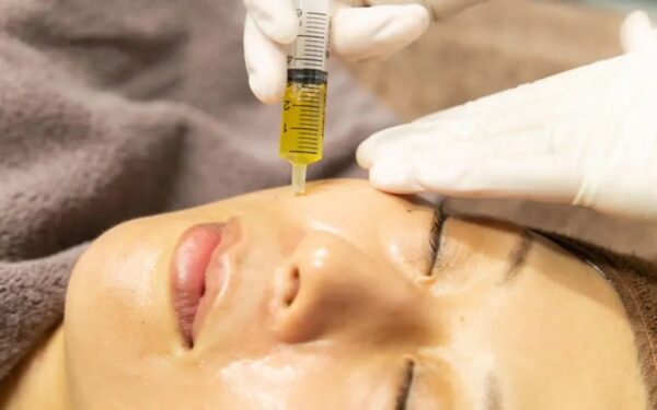 ヴァンパイアフェイシャル