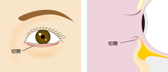 切開を伴うクマ取り
