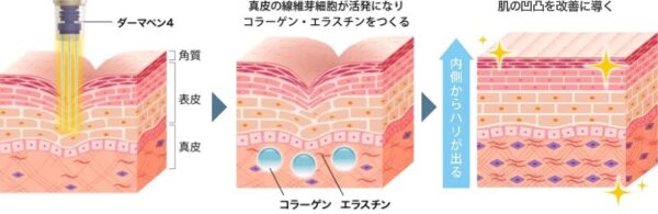 ダーマペン4の仕組みと期待できる効果