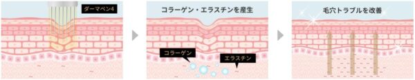 ダーマペン4の仕組みと期待できる効果