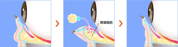 TCB_脱脂
