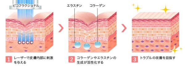 フラクショナルレーザー
