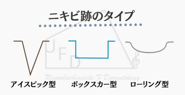 クレーターの3つのタイプ