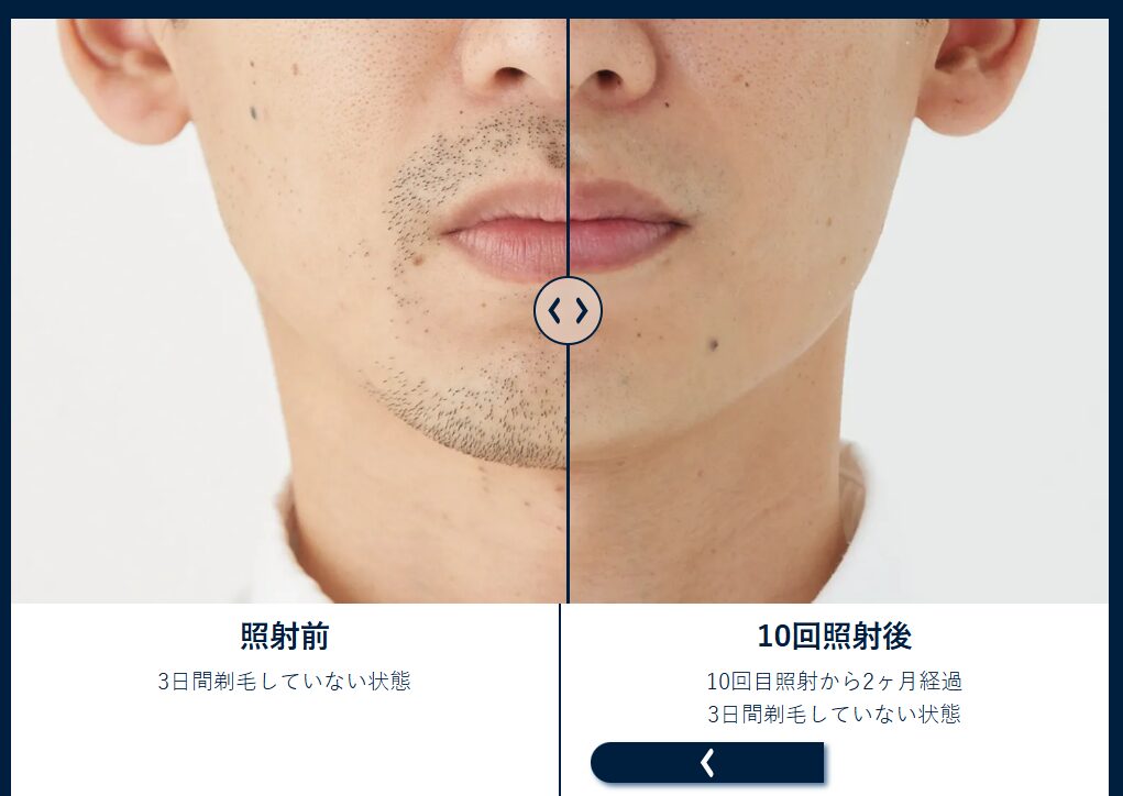 メンズリゼ