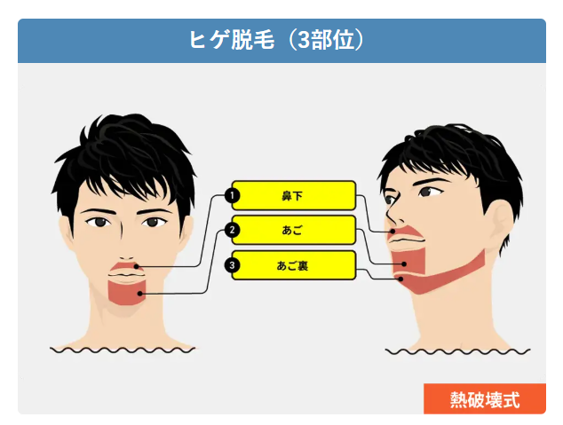 メンズリゼ