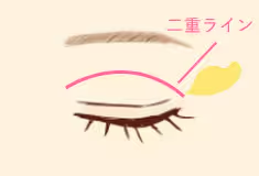 湘南_切開法
