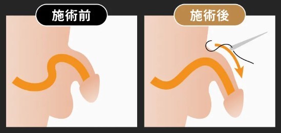 ABCクリニックの長茎術イメージ
