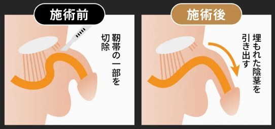 ABCクリニックの長茎術イメージ