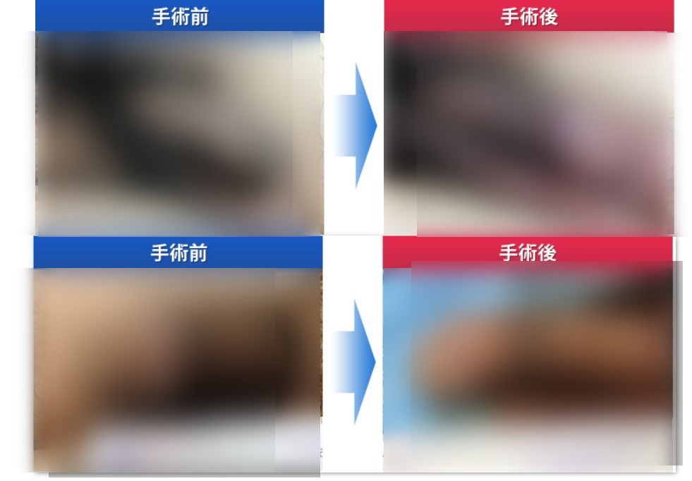 ABCクリニックの長茎術の症例