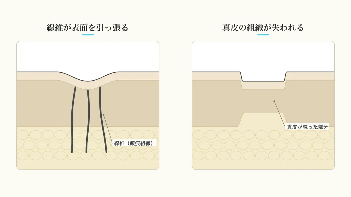 ニキビ跡が凹んだまま残る2つの理由を示す皮膚の断面図（線維が表面を引っ張る／真皮の組織が失われる）