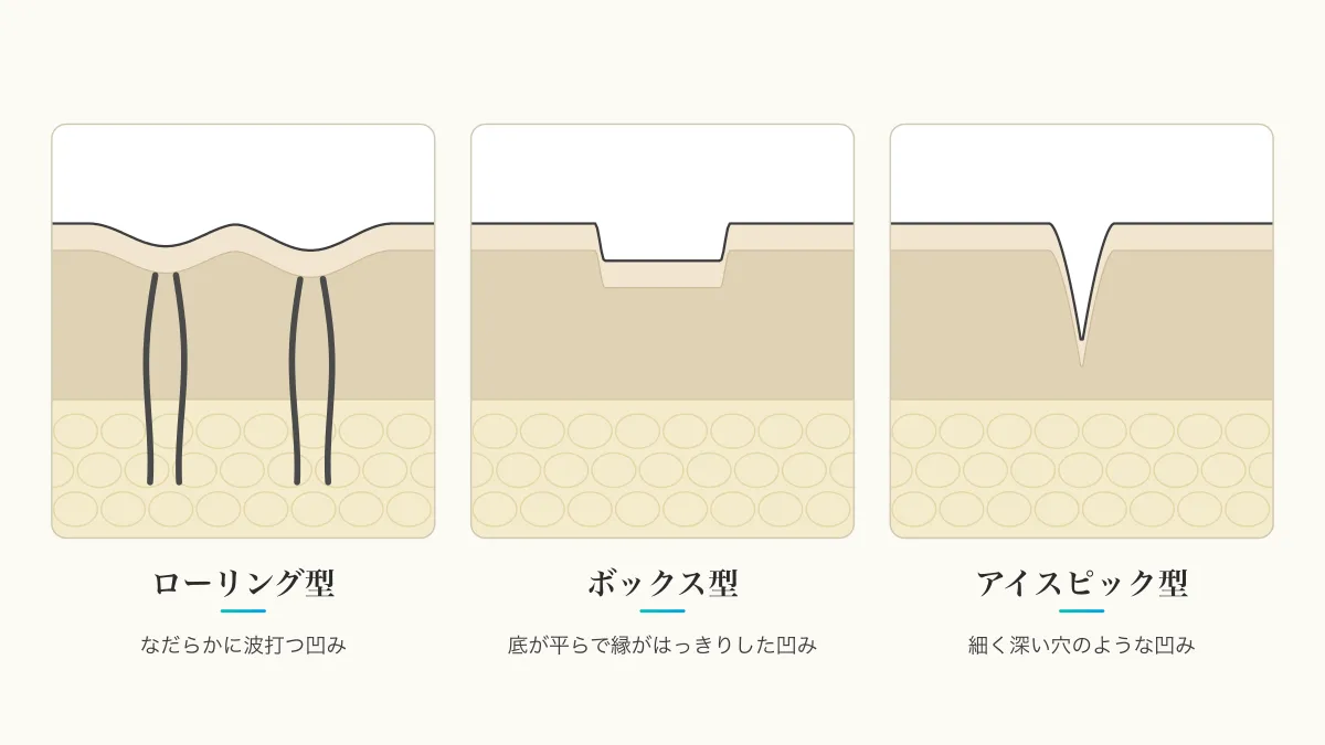 ニキビ跡の3つの型（ローリング型・ボックス型・アイスピック型）を示す皮膚の断面図