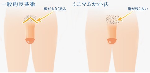 メンズライフクリニック長茎術イメージ