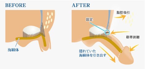 長茎術のイメージ